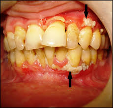 Herpes simplex virus two further conditions, seen especially in children, are herpetic gingivostomatitis and herpetic whitlow. Trench Mouth The American Journal Of Medicine