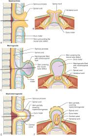 Image result for Dysraphism