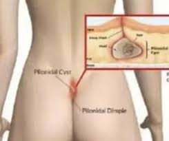 Why do peoples' collar bones stick out? Should I Be Worried That My Tailbone Sticks Out Like A Ball Of Bone Just At The Top Of My Butt Crack Quora