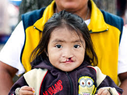 Operation Smile