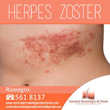 Es causado por el virus de herpes zóster. La Culebrilla O Herpes Centro Dermatologico Del Oriente Facebook