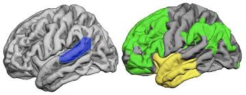 Processi espansivi (di solito tumori) emisferici sinistri, frontali o temporali, che causano un'afasia progressiva. Ridisegnata La Mappa Del Linguaggio Nel Cervello