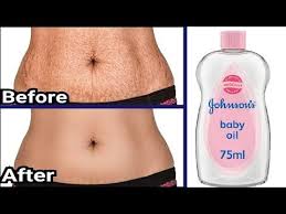 However, you can get stretch marks from bodybuilding. In 5 Days Remove Stretch Marks Completely World S Best Remedy For Fast Stretch Mark Removing Youtube Stretch Marks Skin Tightening Treatments Strech Marks
