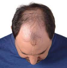The best treatments for hair loss out there are finasteride and minoxidil, often sold under the name brand rogaine. Top 5 Hair Loss Treatments For Men