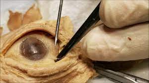 Maybe you would like to learn more about one of these? Exenterated Eyeball 1 Conjunctival Dissection With Clinical Aspects Sanjoy Sanyal Youtube