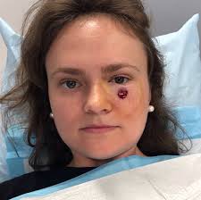 Image result for skin cancer on nose pimple