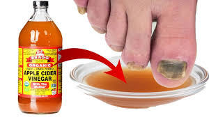 How To Use Apple Cider Vinegar For Toenail Fungus Ostomy Lifestyle