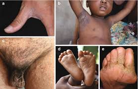 Image result for scabies human children