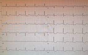 Review the ecg (ekg), present it according to the structure in ecg interpretation and attempt a diagnosis before clicking on the plus symbol to see the answer. Ekg Case Schon Wieder Ein Acs Oder Nerdfallmedizin De