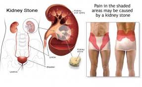 13 Warning Signs You Ll Get Kidney Stones In The Future And How To Prevent Them Kidney Stones Kidney Stones Symptoms Kidney Symptoms