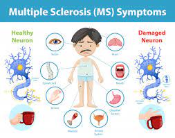 It affects more than 25,000 people in australia and is 3 times more common in women than in men. How Does Multiple Sclerosis Affect The Brain Spinal Cord And Immune System Gigadocs Online Appointment With Best Doctors Blogs