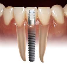 Maybe you would like to learn more about one of these? Is There An Age Restriction For Dental Implants Austin Oral Surgery