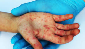 Image result for vyrážka u dětí