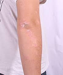 Se o couro cabeludo estiver afectado, passar o. Cercada De Preconceito Psoriase Atinge 2 6 Milhoes De Brasileiros Noticias R7 Saude