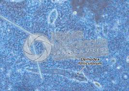 Image result for Demodex folliculorum