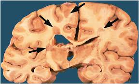 Multiple sclerosis. In a coronal section of brain, multiple sharply... | Download Scientific Diagram
