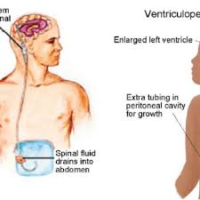 Pdf Mechanisms And Major Sites Of Distal Catheter Migration In Ventriculoperitoneal Shunting Maneuvers A Review Article