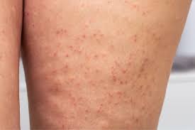 Image result for folliculitis symptoms