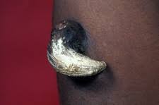 Image result for cornu cutaneum)