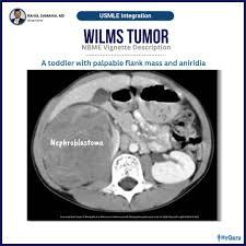 Image result for Nephroblastoma