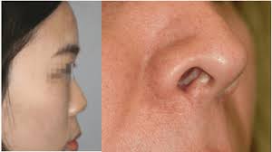 The nose begins swelling and gradually increases in size until the patient undertakes a proper course of treatment. How Can I Fix An Upturned Nose With Overly Exposed Nostrils