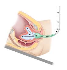 Image result for Uterine Inversion