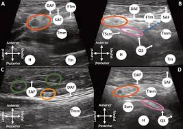 Image result for Axillary Nerve Block