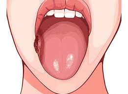 Image result for mouth ulcer on tongue)