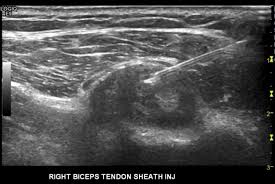Image result for Biceps Tendon Injection