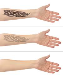 Inkoff.me started in 2012 to respond to the growing needs of family and friends to remove tattoos. Laser Tattoo Removal