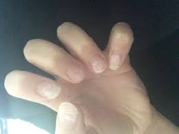My Nails Are Ruined After Acrylics Help The Student Room