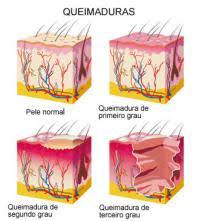 Clinica Deckers Queimaduras