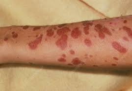 The incidence is about two cases per million people per. Stevens Johnson Syndrome Keyword Search Science Photo Library