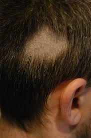 When the pores get blocked, sebum can't get out and sebum starts accumulating causing these bumps. Hair Loss Forum Fue White Dots