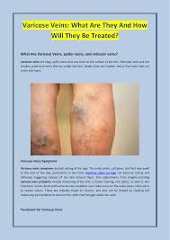 Varicose Veins What Are They And How Will They Be Treated