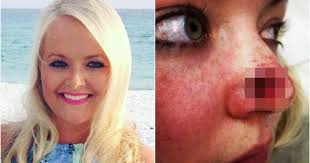 Žena chodila do solária 3-krát týždenne počas 11 rokov. Diagnostikovali jej  rakovinu a na nose sa jej vytvorila veľká diera