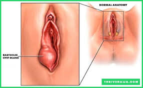Cyst abscess drainage and marsupialization. Bartholin Cyst Home Treatment 10 Remedies That Works
