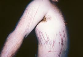 Senile purpura is benign, easy bruising that affects older adults. Purpura And Other Hematovascular Disorders Sciencedirect