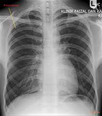 The pressure causes the lung to give way, at least partly. Pneumothorax Collection Of Plain X Rays