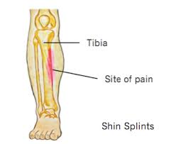 It might be a sign of some other problem. Focus On Shin Splints Rural Physio At Your Doorstep