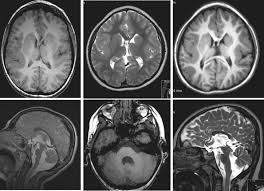 The cortex is thickened and normal typical appearance of lissencephaly type i, with no normal gyration visible, lending a figure 8 appearance to. Lissencephaly An Overview Sciencedirect Topics
