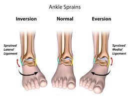 Image result for Ankle Dislocation