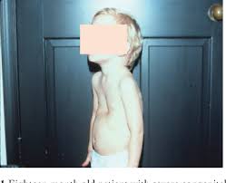 The cartilage pushes the breastbone (sternum) inward. Figure 1 From Pectus Excavatum From A Pediatric Surgeon S Perspective Semantic Scholar