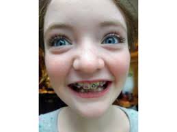 Adventures in Orthodontia Begin