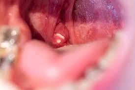 Place the irrigator inside the mouth but not touching the stone, and switch on the oral irrigator on the lowest setting. What Are Tonsil Stones And Should You Be Concerned Call Today 855 614 5221 California Dental Group