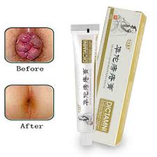 We did not find results for: Ofanyia Natrual Hemorrhoids Cream Anal Cream For Internal Hemorrhoids Piles External Anal Fissure Buy Online In Germany At Desertcart De Productid 73479367