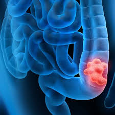 A change in bowel habits (suddenly becoming constipated, for example) Colon Cancer Dr Mike Mills Healthy Happy By Ejc Sda