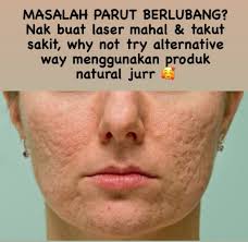 Cara terampuh untuk menghilangkan jerawat di bagian tubuh manapun termasuk jerawat di punggung ialah dengan menggunakan lemon. Tips Rawatan Parut Berlubang Tanpa Laser T9 Skincare