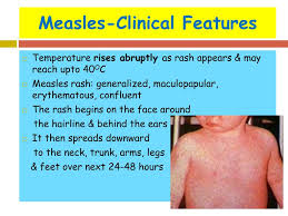 Check spelling or type a new query. Ppt Common Viral Exanthemas Measles Chickenpox Rubella Powerpoint Presentation Id 6929726