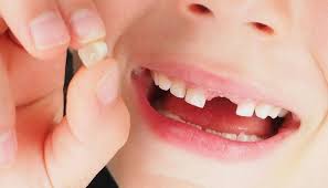 THAY RĂNG SỮA Ở TRẺ EM: NHỮNG ĐIỀU QUAN TRỌNG MÀ CHA MẸ CẦN BIẾT - Cổng  thông tin bệnh viện Bạch Mai